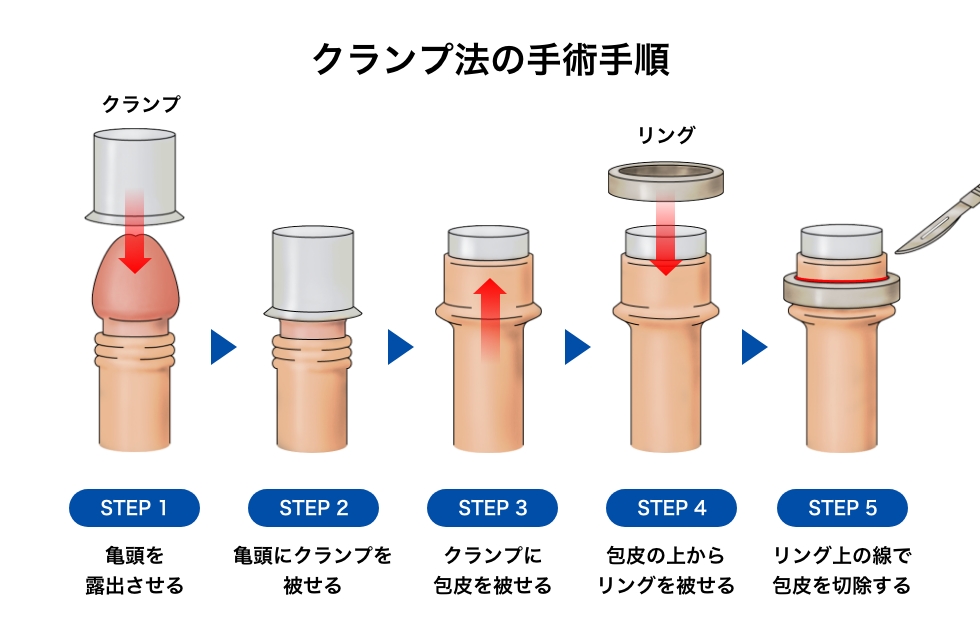 クランプ法の手術手順