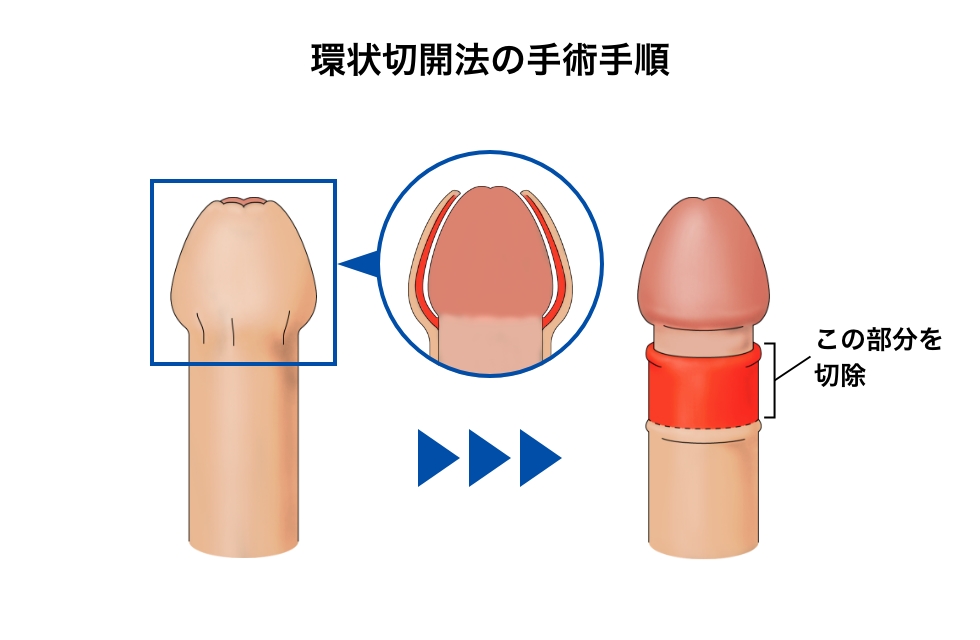 環状切開法の手術手順