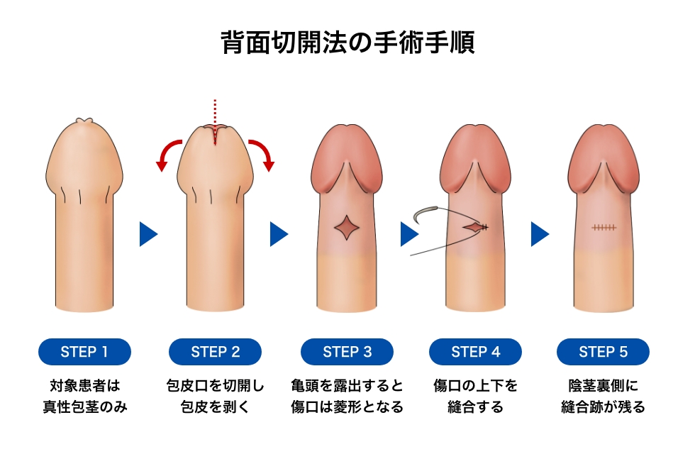 背面切開法の手術手順