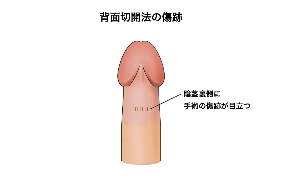 背面切開法の傷跡