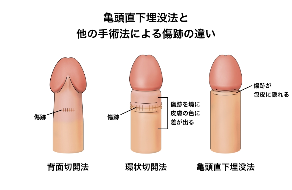 亀頭直下埋没法と他の手術法による傷跡の違い